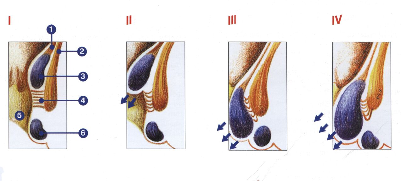 stades de développement des hémorroïdes