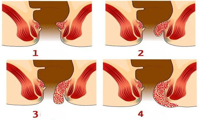 à quoi ressemblent les hémorroïdes à différents stades